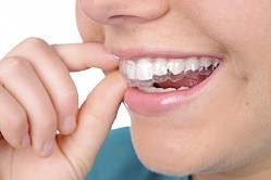 unsichtbare Schienen für Ästhetische Zahnstellungskorrektur